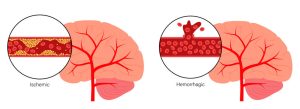 Brain Stroke: A Neurologist’s Experience with Causes, Treatment, and Prevention