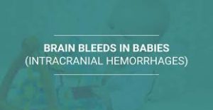 Brain Bleeding (Intracranial Hemorrhage): A Neurologist’s Real-Life Experience