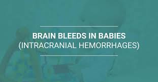 Brain Bleeding (Intracranial Hemorrhage): A Neurologist’s Real-Life Experience